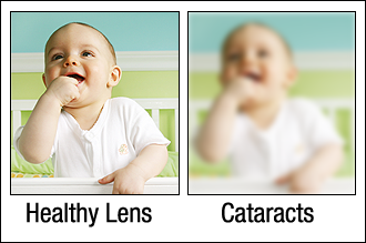 Healthy lens vs cataract