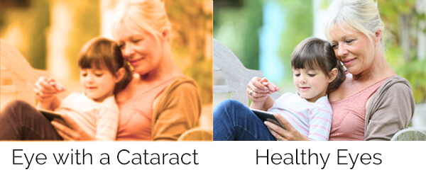 Eyes with a cataract vs healthy eyes